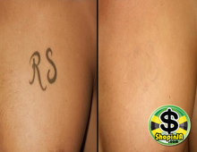 Before-and-After-Tattoo-Removal