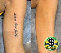 laser+tattoo+removal+Adelaide+m